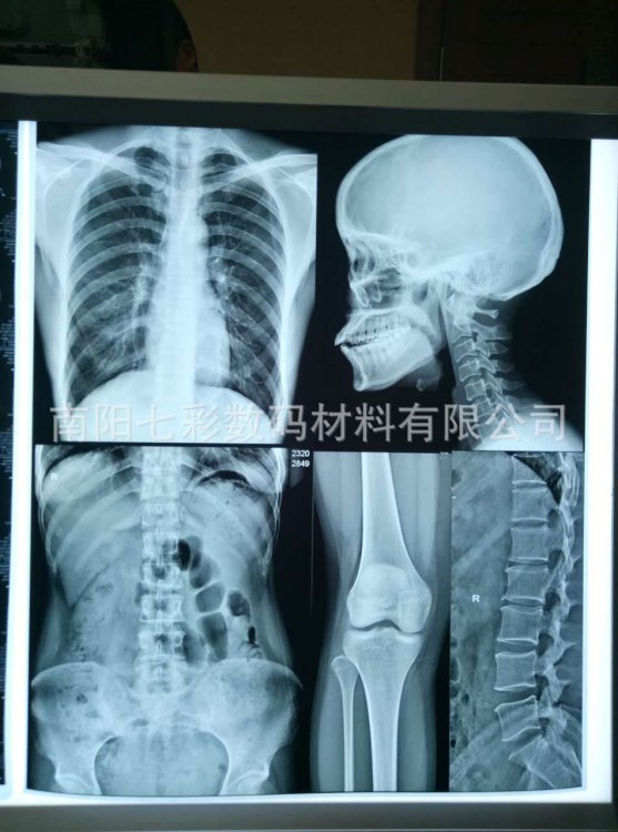 放射科10*12&rdquo;醫(yī)用藍基CT CR DR X光磁共振激光打印膠片