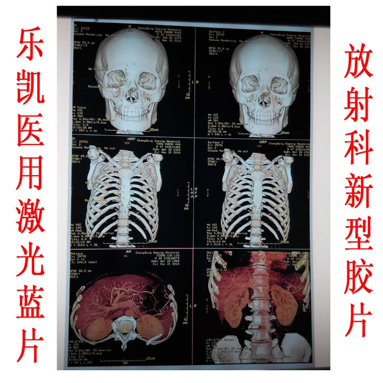 放射科噴墨打印膠片