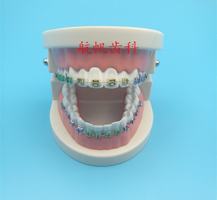 牙科口腔矯正帶金屬托槽假牙模型 醫(yī)患溝通教學(xué)正畸模型牙齒模型